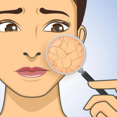 5 простих речей, які захистять суху шкіру взимку