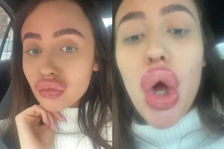 збільшення губ